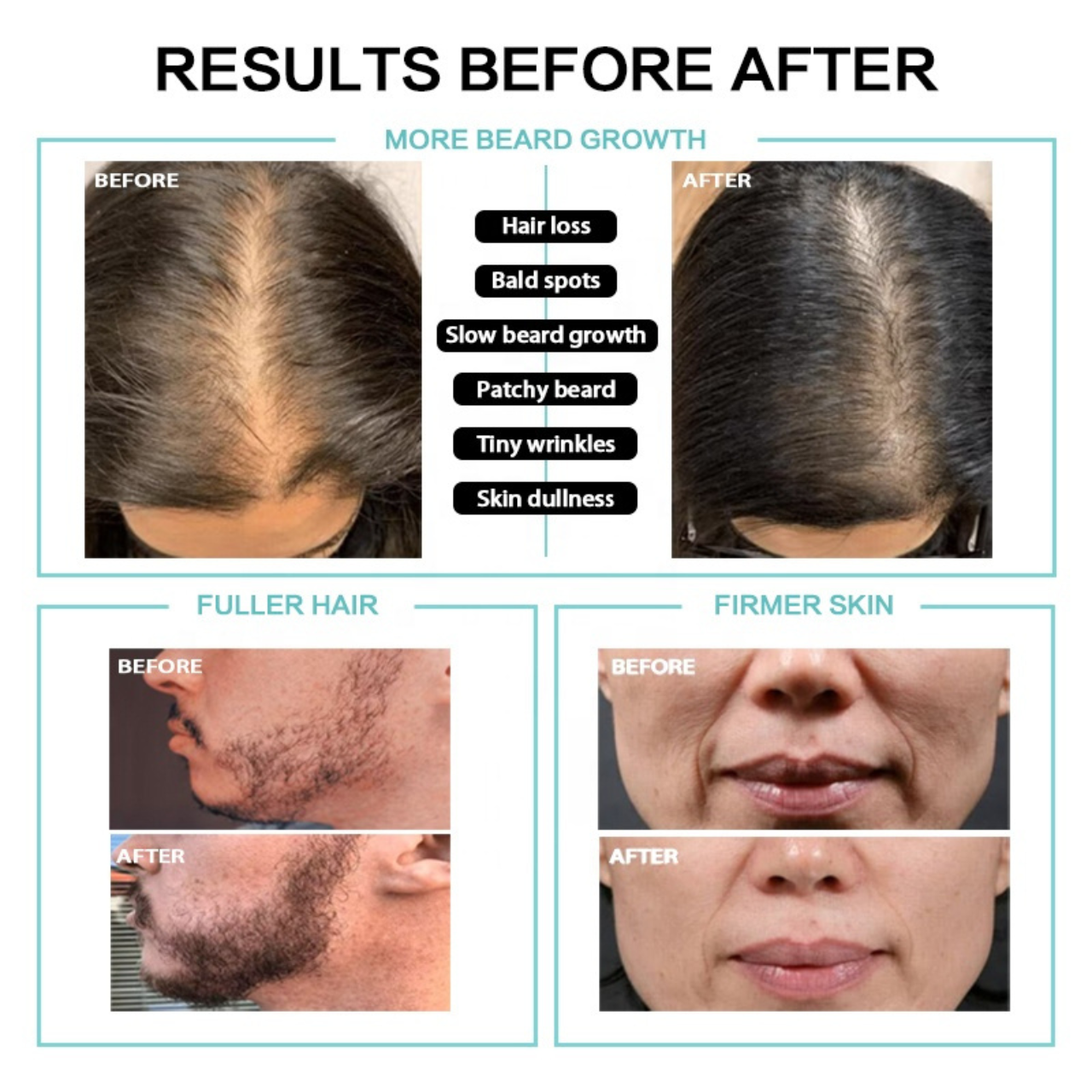 Derma Roller