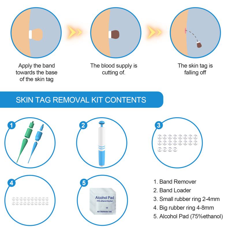 Moles Skin Tag Warts Remover Device for Medium/Large Skin Tags Wart