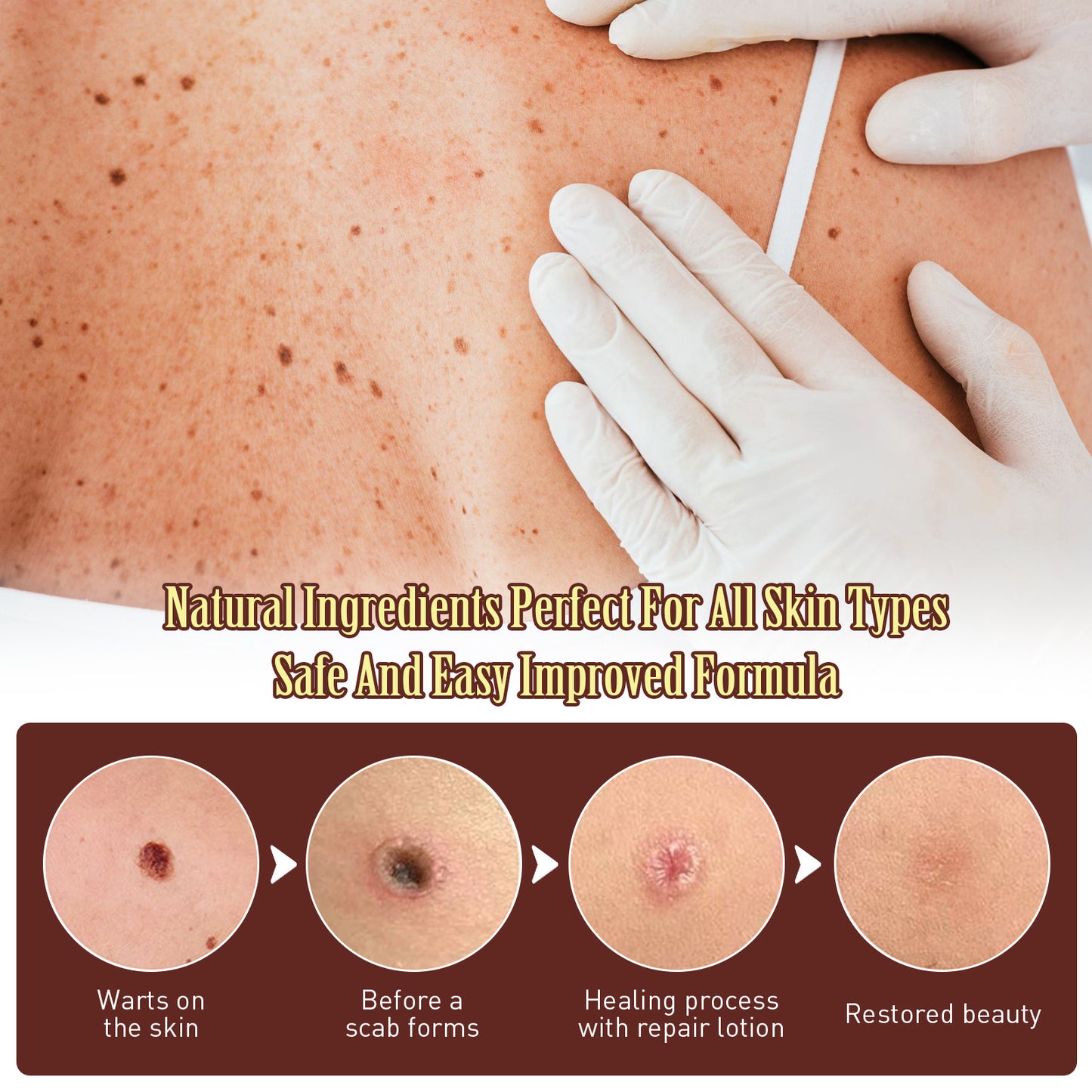 Mole Removal Cream Helosis Repair Deep Cleaning Smoothing Skin Wart Removal Cream