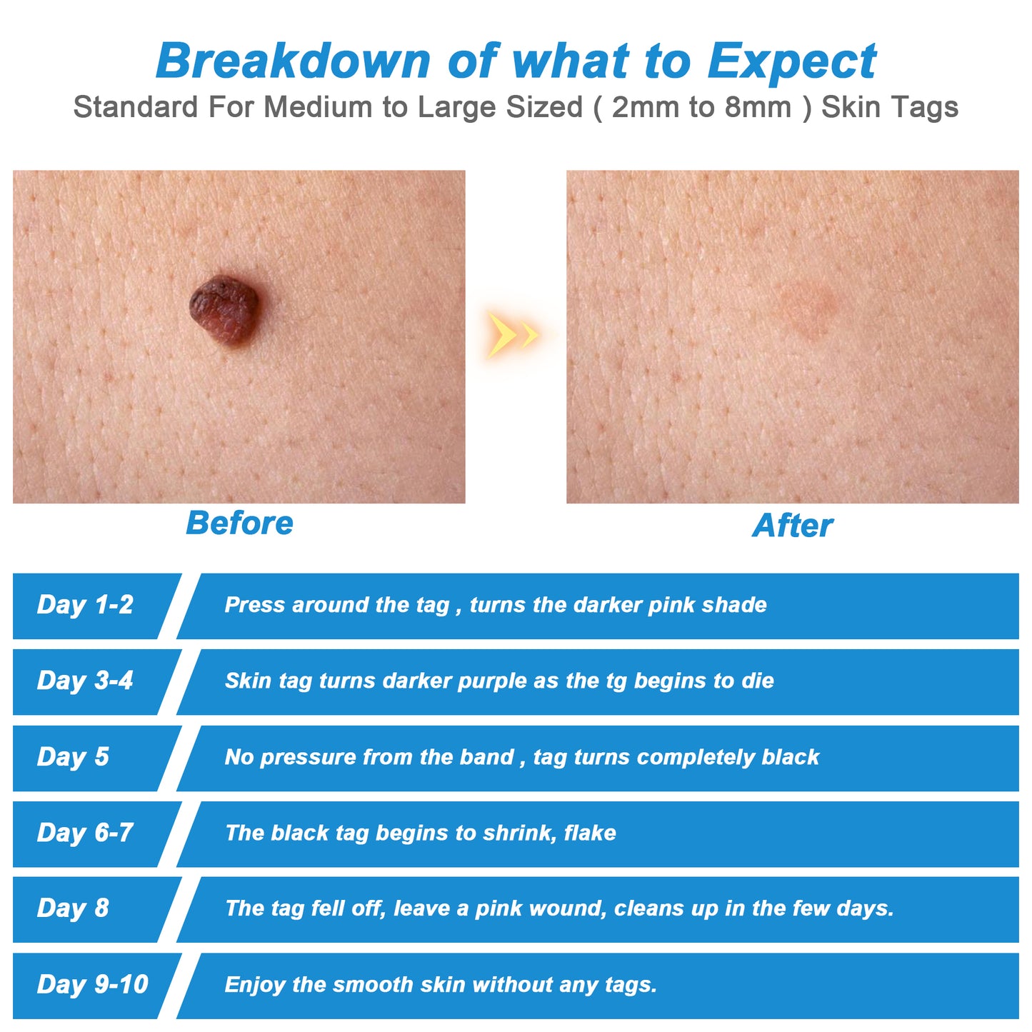 Moles Skin Tag Warts Remover Device for Medium/Large Skin Tags Wart