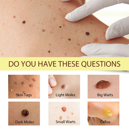 Mole Removal Cream Helosis Repair Deep Cleaning Smoothing Skin Wart Removal Cream